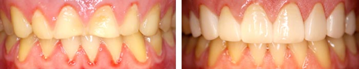 Porcelain crowns